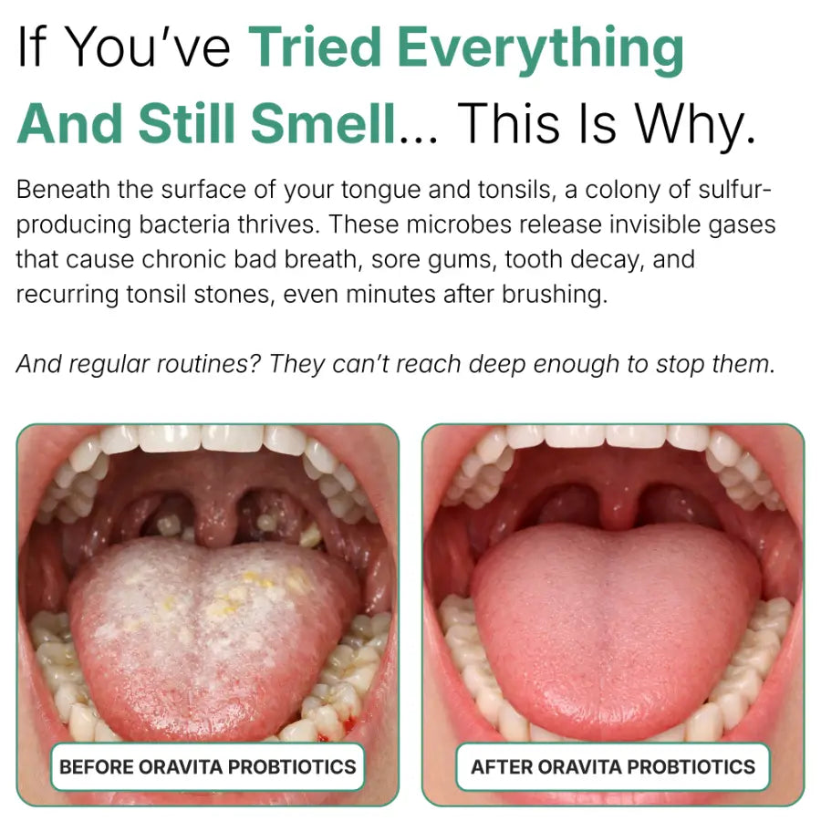Oravita Oral Probiotic – Targets the Root Cause of Bad Breath & Tonsil Stones